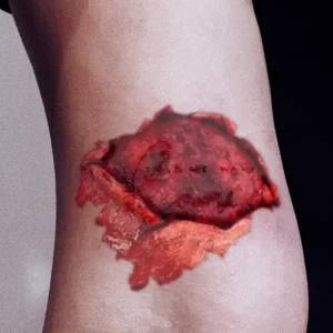 Foto av arm med uppfläkt blodigt sår med resterna av en tatuering